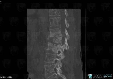 Spondylodiscite, Corps vertébral / Disque, Scanner