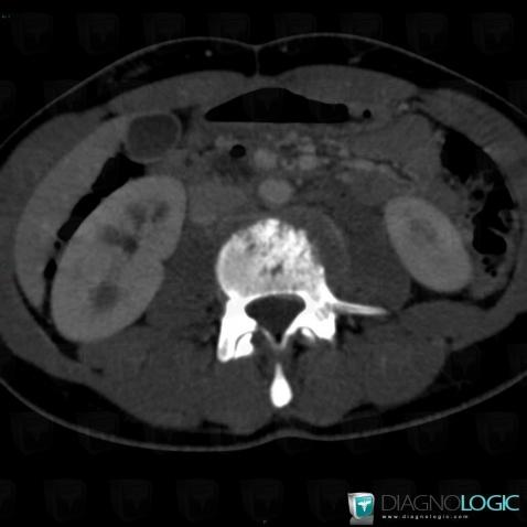 Spondylodiscite, Paravertébral, Scanner