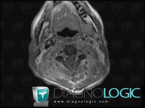 Spondylodiscitis, Deep facial spaces, MRI