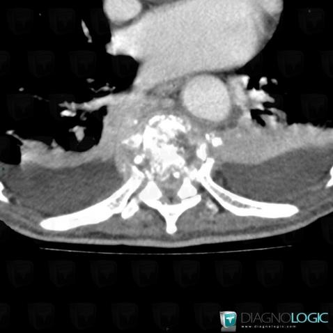 Spondylodiscitis, Mediastinum, CT