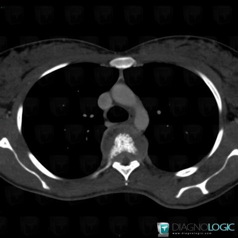 Spondylodiscitis, Mediastinum, Spinal canal / Cord, CT