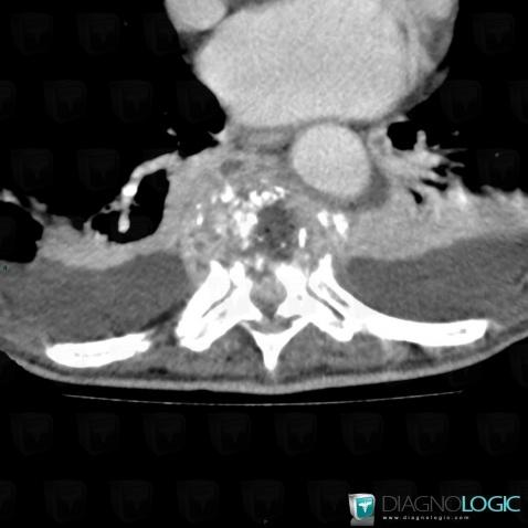 Spondylodiscitis, Spinal canal / Cord, CT