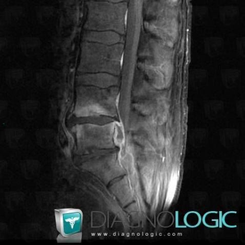 Spondylodiscitis, Spinal canal / Cord, MRI