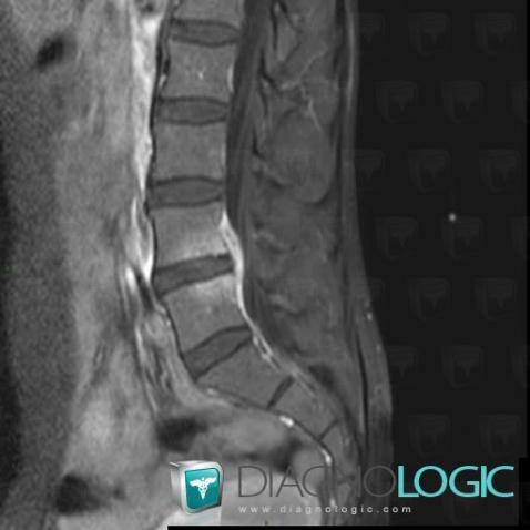 Spondylodiscitis, Spinal canal / Cord, MRI