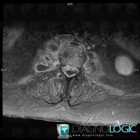 Spondylodiscitis, Spinal canal / Cord, MRI