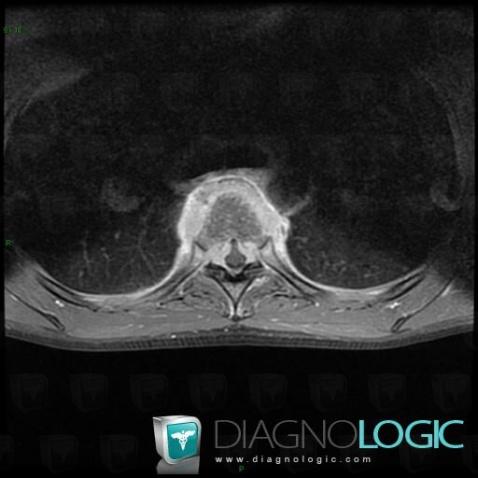 Spondylodiscitis, Spinal canal / Cord, Paraspinal, MRI