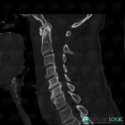 Spondylodiscitis, Vertebral body / Disk, CT