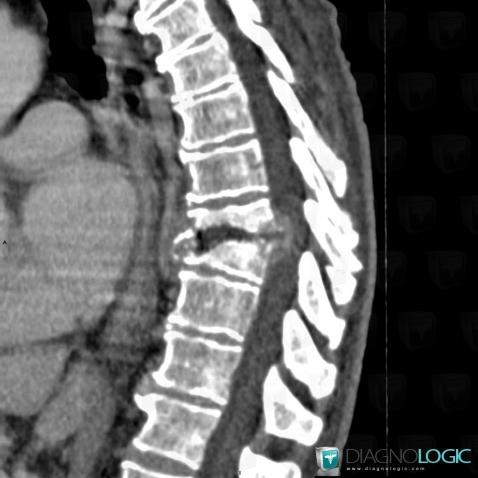 Spondylodiscitis, Vertebral body / Disk, CT