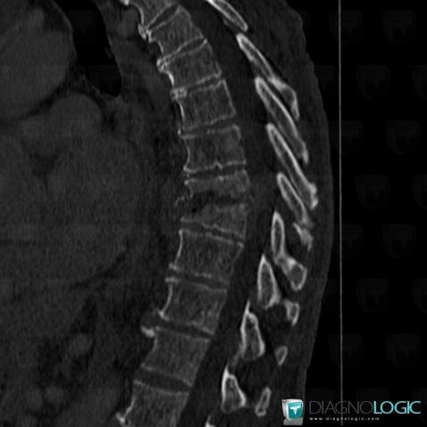 Spondylodiscitis, Vertebral body / Disk, CT