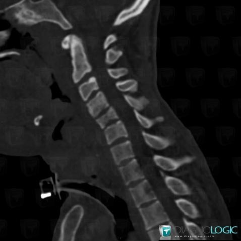 Spondylodiscitis, Vertebral body / Disk, CT