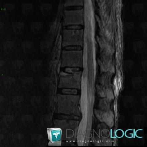 Spondylodiscitis, Vertebral body / Disk, MRI