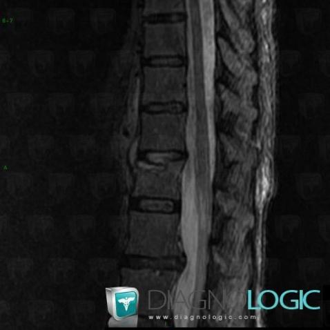 Spondylodiscitis, Vertebral body / Disk, MRI