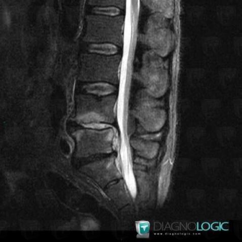 Spondylodiscitis, Vertebral body / Disk, MRI