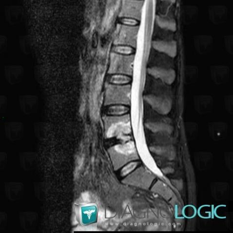 Spondylodiscitis, Vertebral body / Disk, MRI