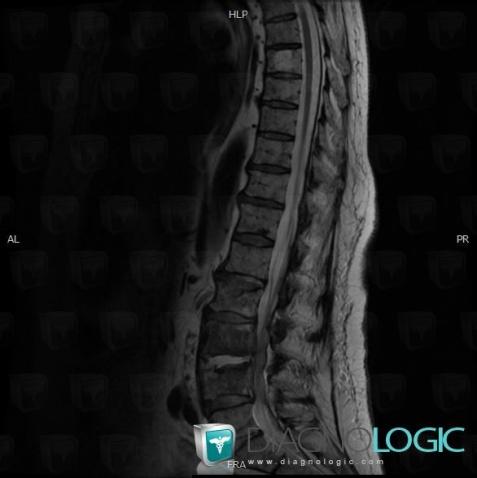Spondylodiscitis, Vertebral body / Disk, MRI