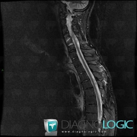 Spondylodiscitis, Vertebral body / Disk, MRI