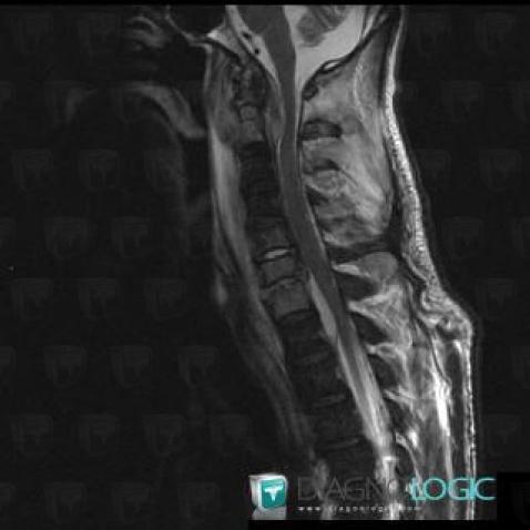 Spondylodiscitis, Vertebral body / Disk, Spinal canal / Cord, MRI