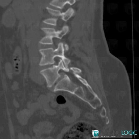 Spondylolyse, Corps vertébral / Disque, Scanner