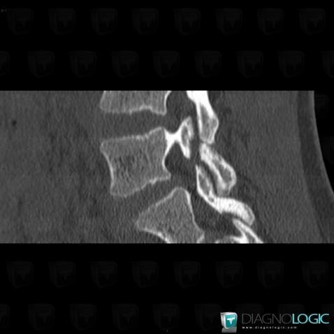 Spondylolysis, Vertebral body / Disk, CT