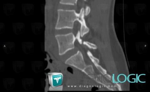 Spondylolysis, Vertebral body / Disk, CT