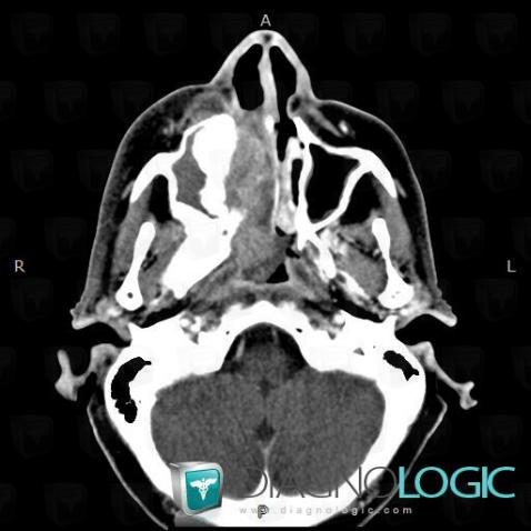 Radiology case : Squamous cell carcinoma (CT) - Diagnologic