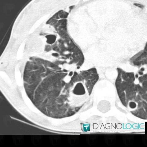 Staphylococcie pleuro-pulmonaire, Parenchyme pulmonaire, Scanner