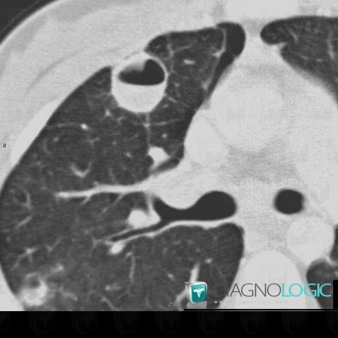 Staphylococcie pleuro-pulmonaire, Parenchyme pulmonaire, Scanner