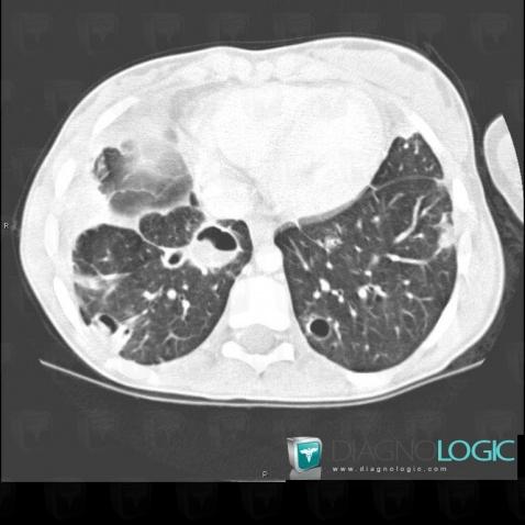 Staphylococcie pleuro-pulmonaire, Parenchyme pulmonaire, Scanner