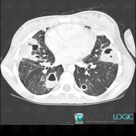 Staphylococcie pleuro-pulmonaire, Parenchyme pulmonaire, Scanner