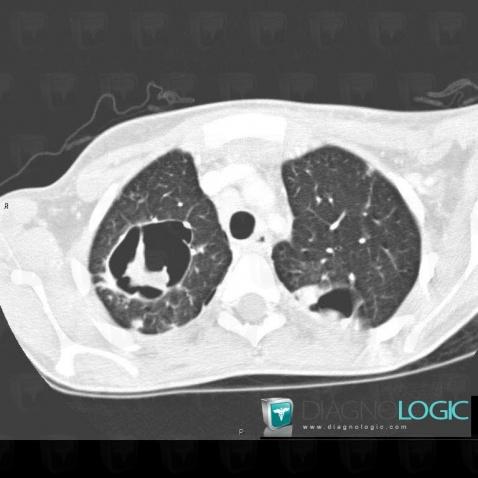 Staphylococcie pleuro-pulmonaire, Parenchyme pulmonaire, Scanner