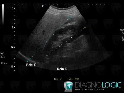 Stéatose, Foie, Echographie