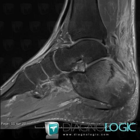 Stress fracture, Calcaneus, MRI