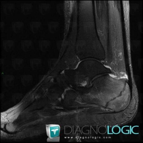 Stress fracture, Calcaneus, MRI