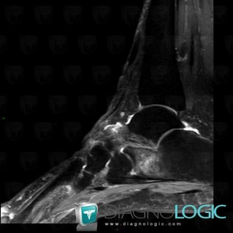 Stress fracture, Calcaneus, MRI