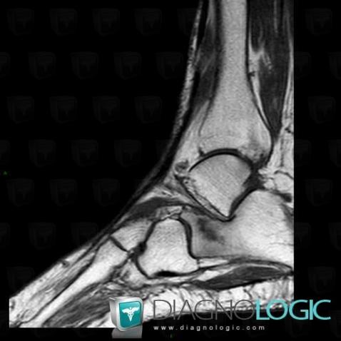 Stress fracture, Calcaneus, MRI