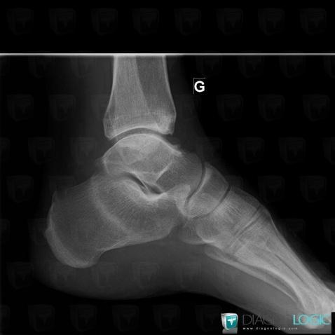 Stress fracture, Calcaneus, X rays