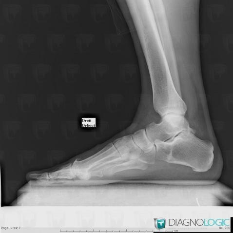 Stress fracture, Calcaneus, X rays