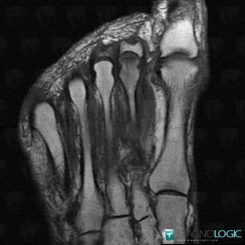 Stress fracture, Metatarsal bones, MRI