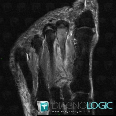 Stress fracture, Metatarsal bones, MRI