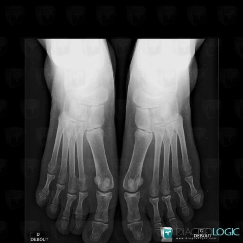 Stress fracture, Metatarsal bones, X rays