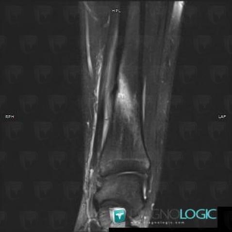 Stress fracture, Tibia - Distal part, MRI