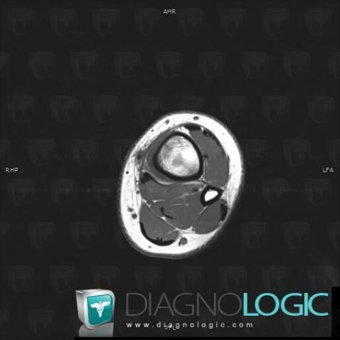 Stress fracture, Tibia - Distal part, MRI