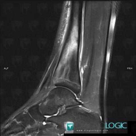 Stress fracture, Tibia - Distal part, MRI