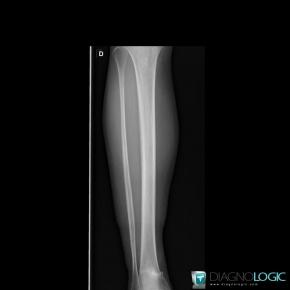 Stress fracture, Tibia - Distal part, X rays