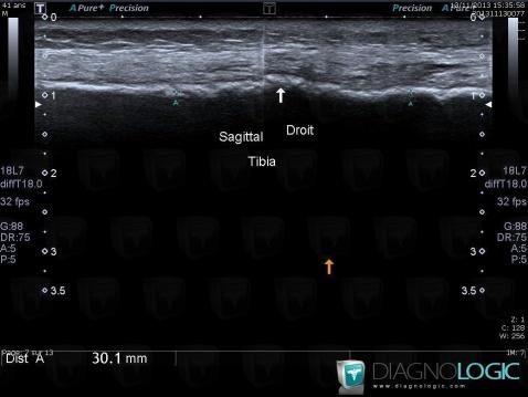 Stress fracture, Tibia - Mid part, Tibia - Distal part, US