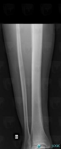 Stress fracture, Tibia - Mid part, Tibia - Distal part, X rays