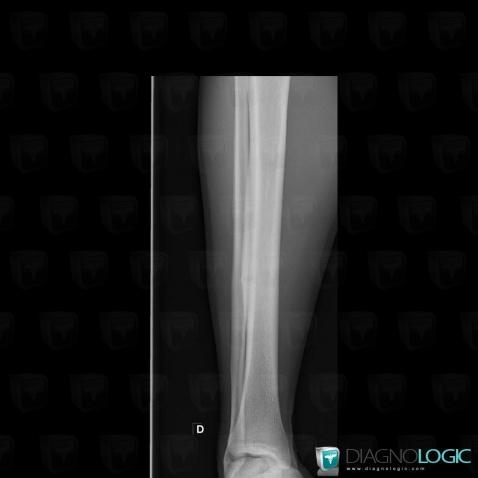 Stress fracture, Tibia - Mid part, X rays