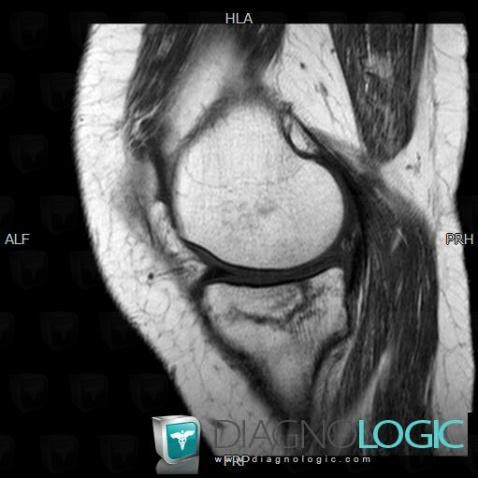 Stress fracture, Tibia - Proximal part, MRI