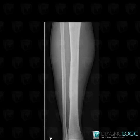 Stress fracture, X rays