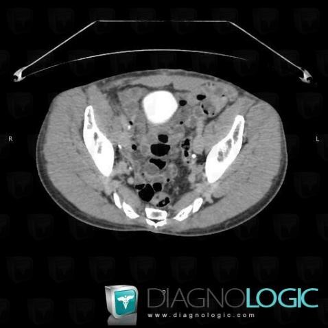 Stricture, Ureter, CT